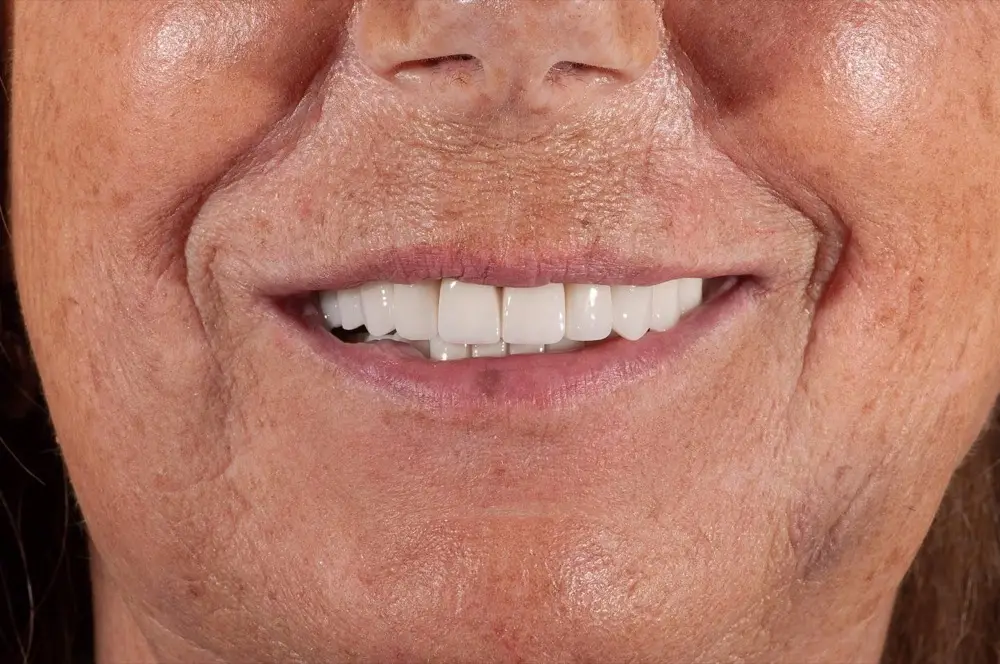 Zirconium crowns: after treatment