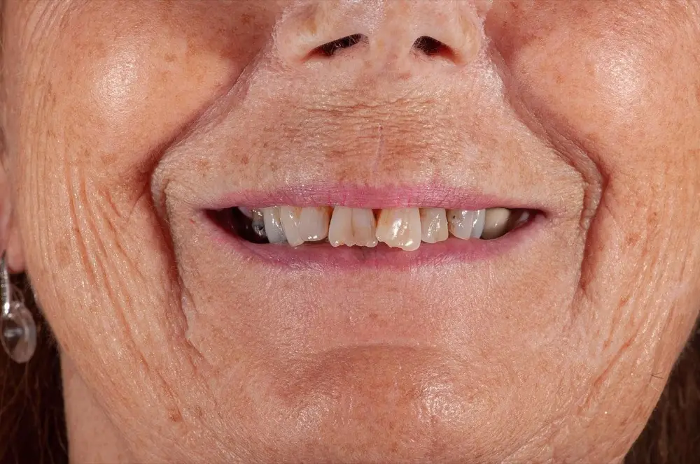 Zirconium crowns: before treatment