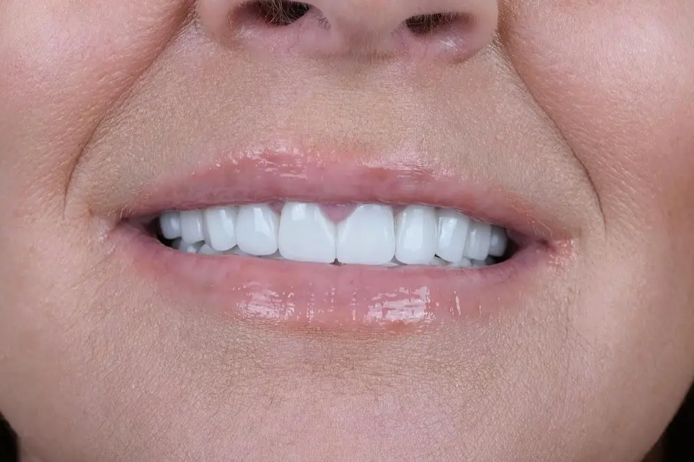 Hollywood smile: after treatment