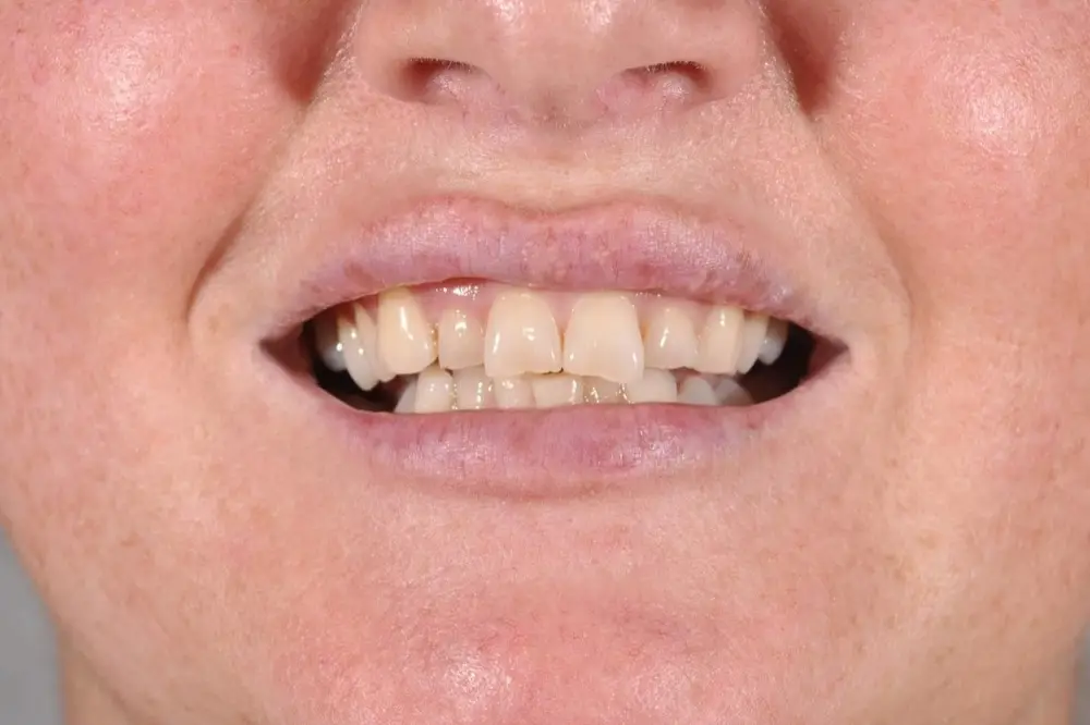 Hollywood smile: before treatment