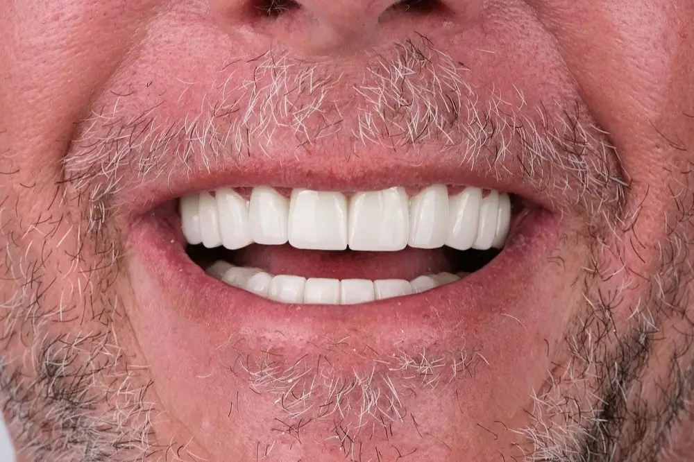 Full-mouth crowns: after treatment