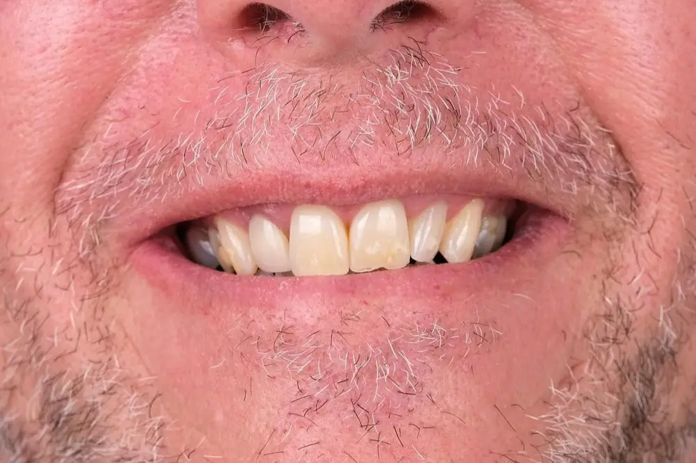 Full-mouth crowns: before treatment