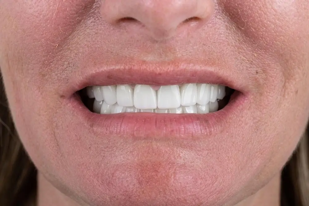 Zirconium crowns: after treatment