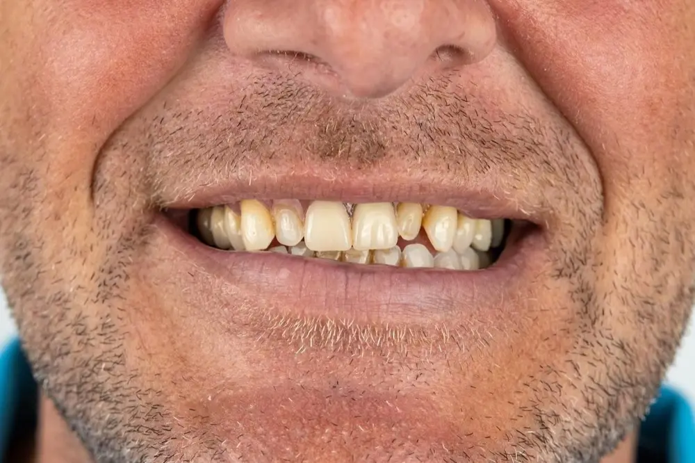 Zirconium crowns: before treatment