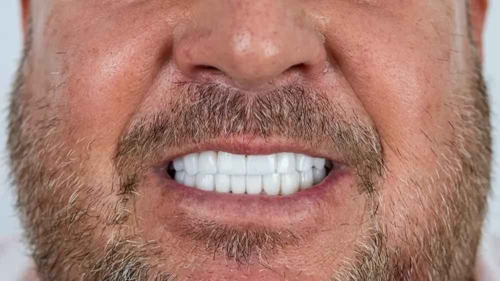 Smile makeover: after treatment