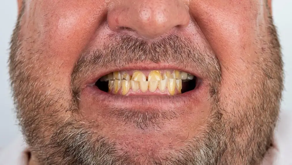 Smile makeover: before treatment