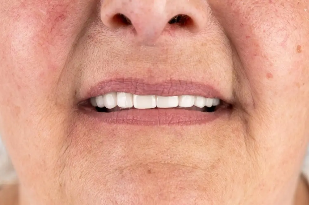 E-max veneers: after treatment