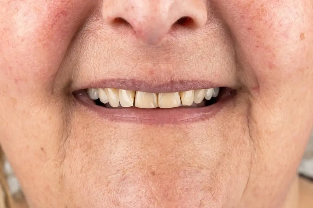 E-max veneers: before treatment