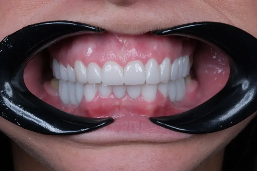 Smile makeover: after treatment