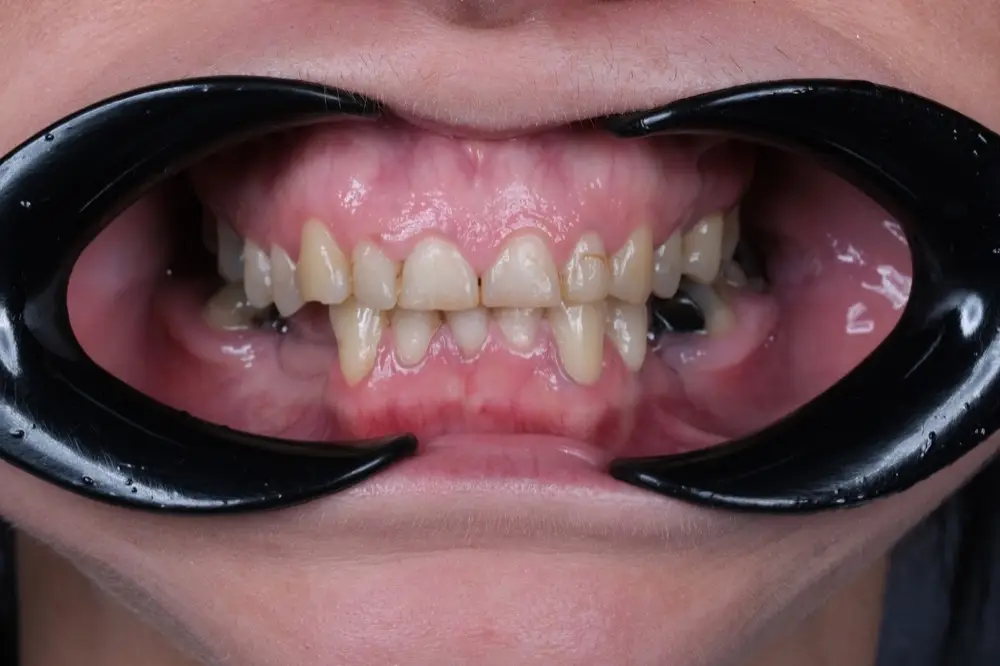 Smile makeover: before treatment