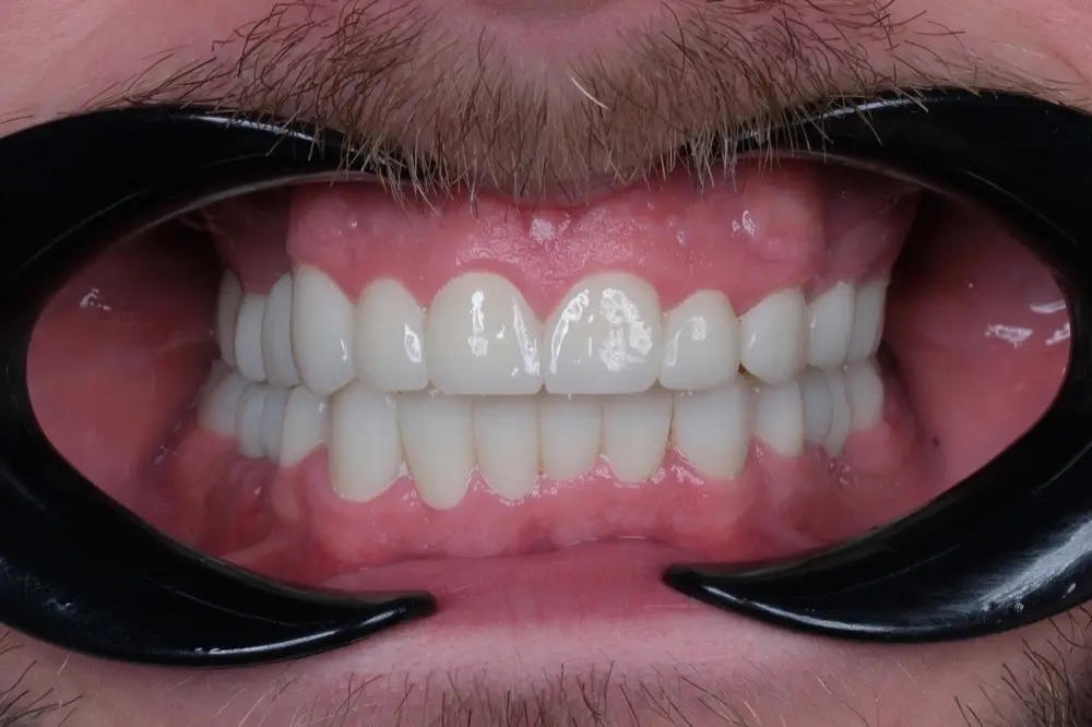 Smile makeover: after treatment