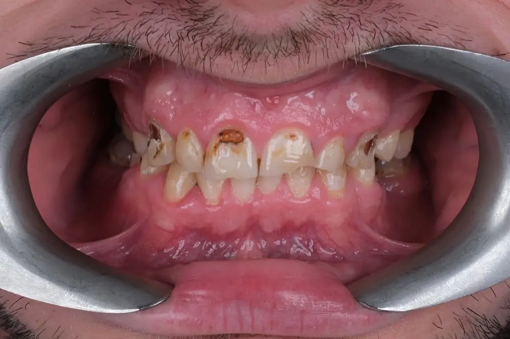Smile makeover: before treatment
