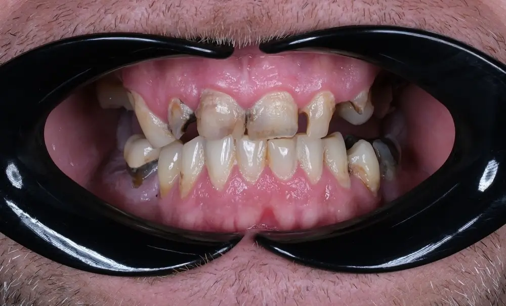 Smile makeover: before treatment