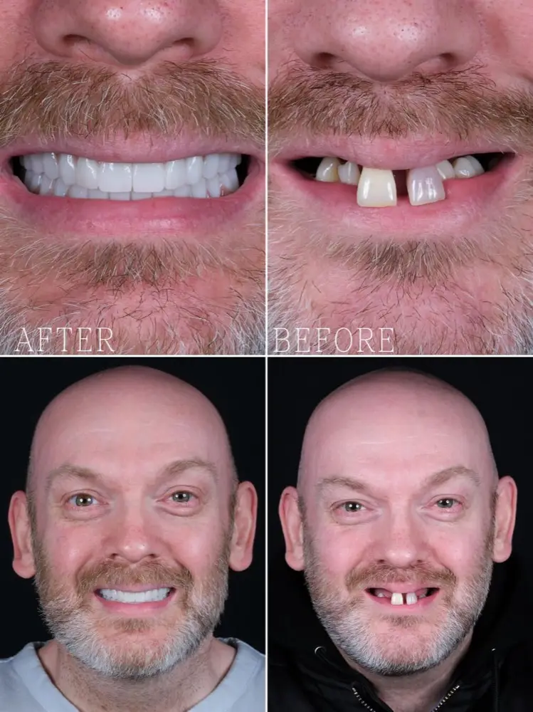 Patient smiles from our Turkish dental clinic