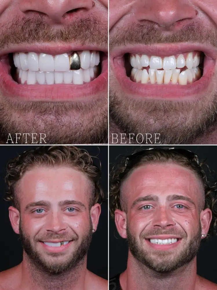 Zirconium crowns, before and after, Precious Dental patient