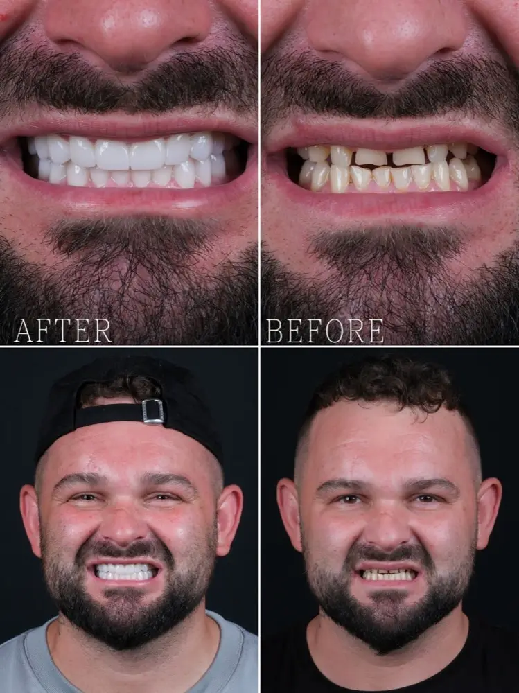 All-on-6, before and after, Precious Dental patient